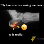 heel spur causing pain, Why heel spurs are not always the cause of heel pain