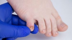 how to treat a fungal nail infection
